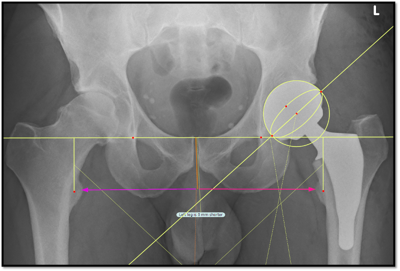 Hip replacement planning X-ray with templating